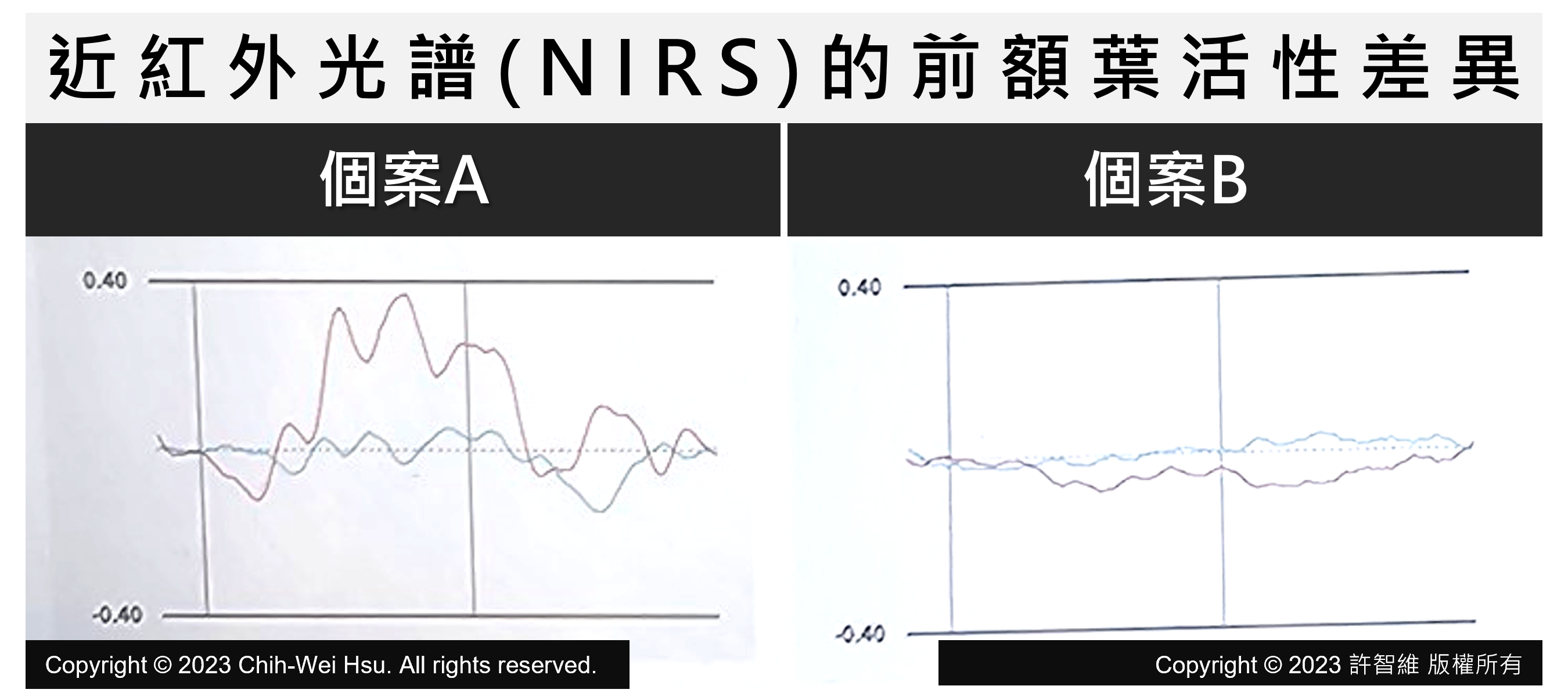 難治型憂鬱症可能是潛在的躁鬱症 [V1]（原文圖片）