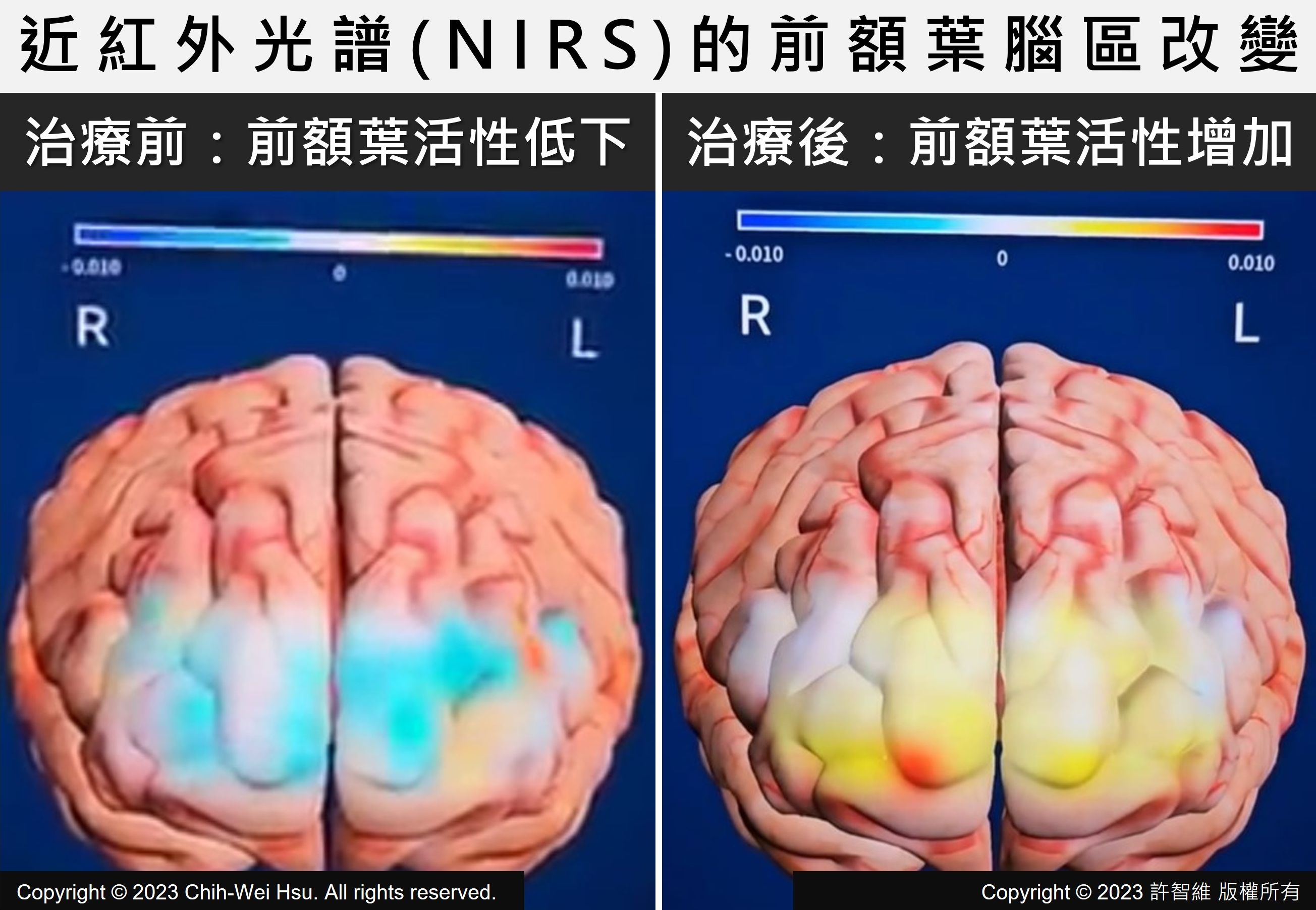 史丹佛加速智能神經調節療法(案例分享)（原文圖片）